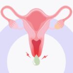 Warning Signs of Vaginitis
