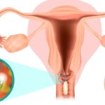 Understanding the Causes, Symptoms, and Treatment of Vaginitis