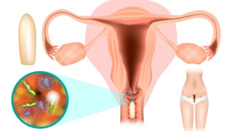 Understanding the Causes, Symptoms, and Treatment of Vaginitis
