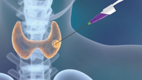 Radiofrequency Ablation (RFA) for Thyroid Nodules: What You Need to Know