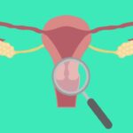 Cervical Cancer Screening Methods