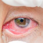 Acute Conjunctivitis: Causes, Symptoms, and Treatments