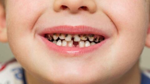 Don’t Overlook Cavities in Baby Teeth in Children