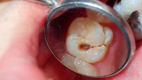 The Growing Prevalence of Molar Cavities in Children: Causes and Solutions