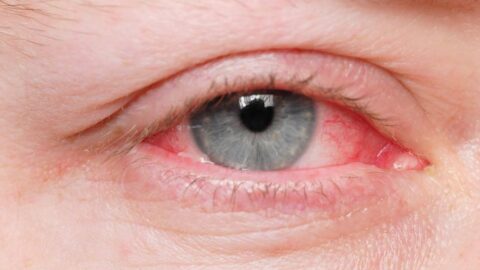 Is Pink Eye Contagious? Understanding Conjunctivitis and Its Spread