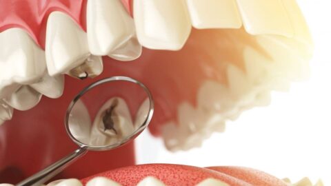 Causes of Tooth Decay Reaching the Pulp