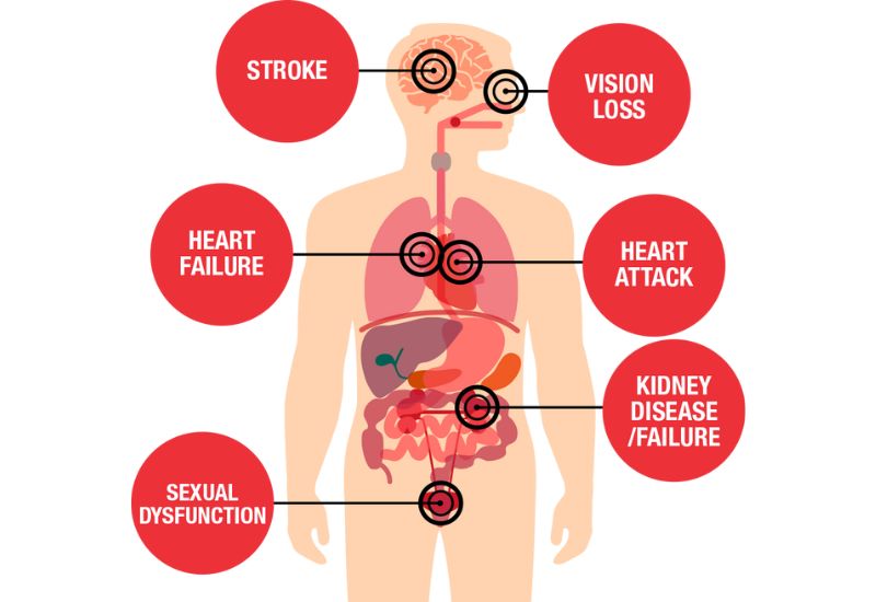 Serious Complications of Hypertension