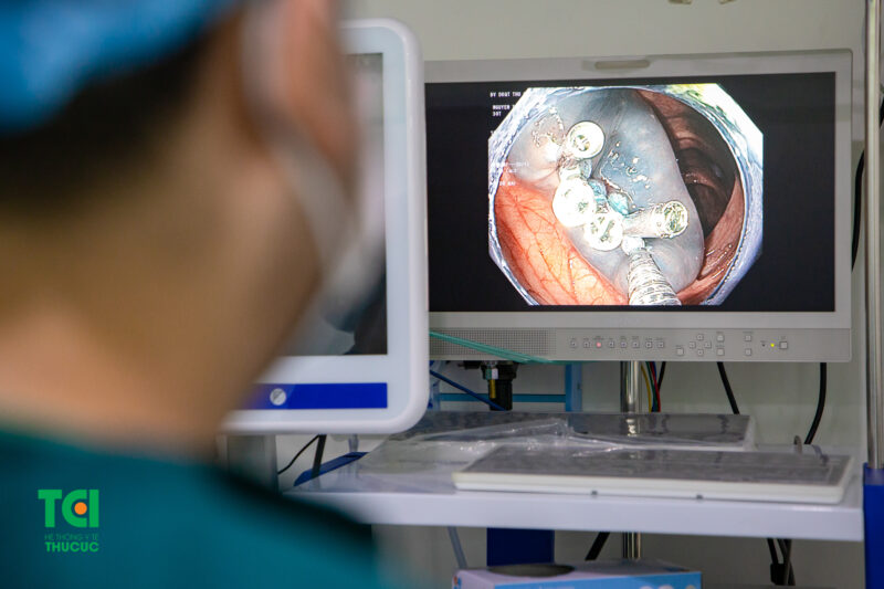 Colonoscopic Polypectomy, a minimally invasive procedure