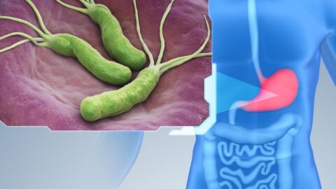 Gastric Ulcers from Helicobacter Pylori Infection: Symptoms and Treatment Options