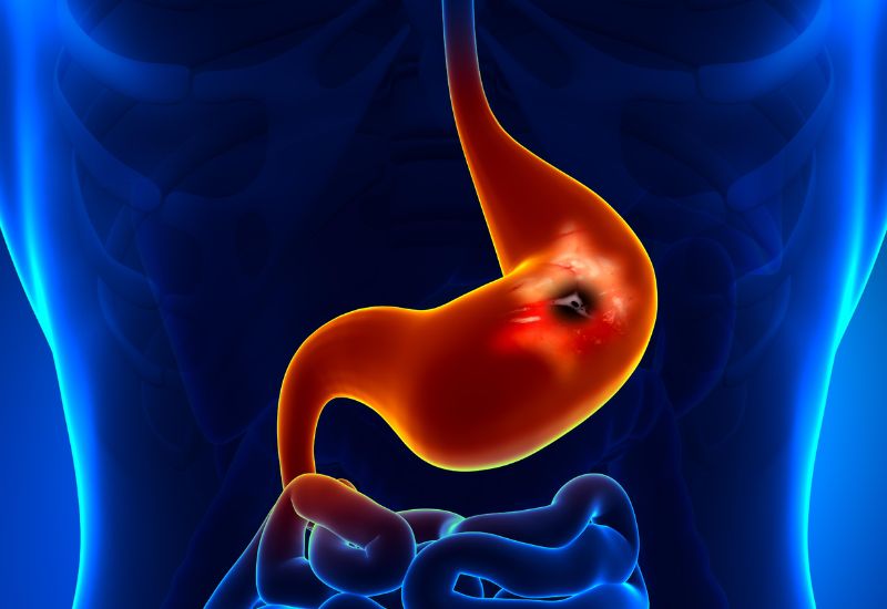 Gastric Ulcers: Causes and Symptoms