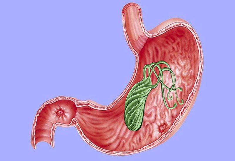 Common Causes of Gastric Ulcers