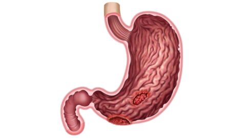 Common Causes of Gastric Ulcers