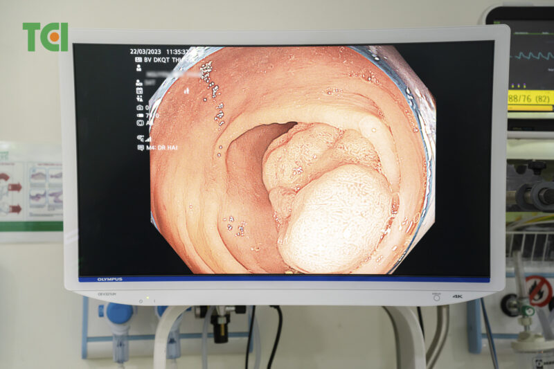 re Colon Polyps Cancerous?