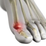 Can Gout be Cured? Understanding Gout and Effective Treatment Strategies