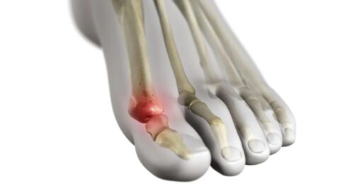 Can Gout be Cured? Understanding Gout and Effective Treatment Strategies