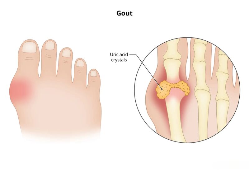 What is Gout?