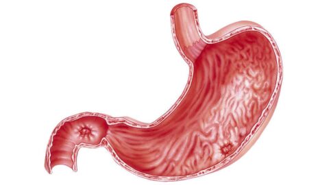 Peptic Ulcer Disease: Symptoms, Causes, and Complications