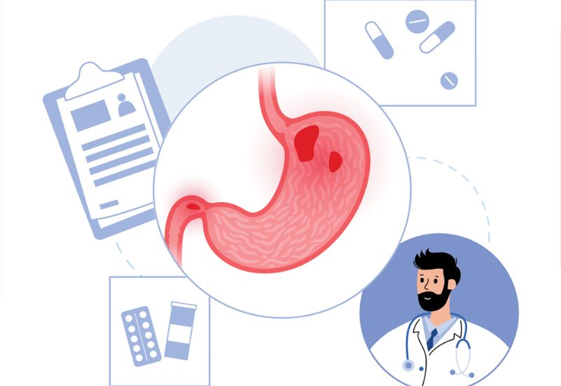 Treatment Methods for Peptic Ulcers