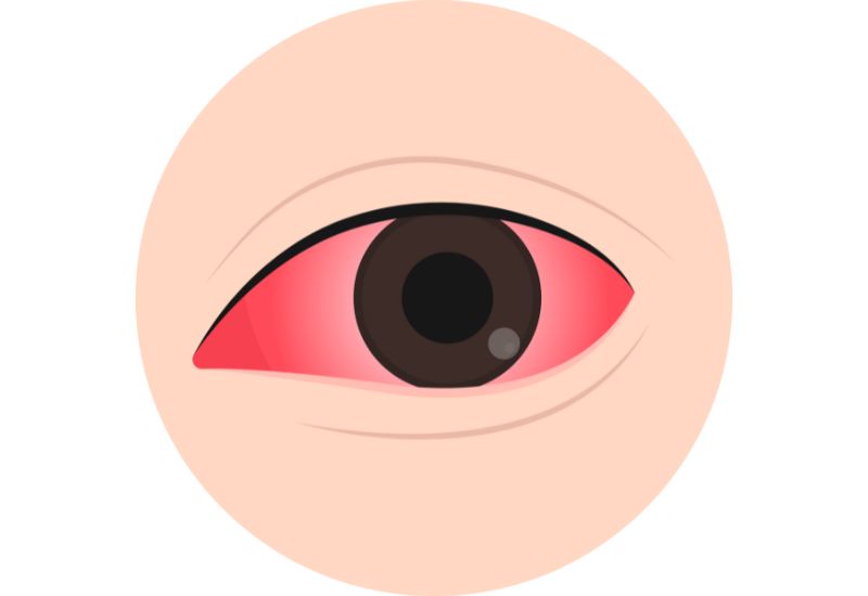 Overview of Pink Eye Symptoms