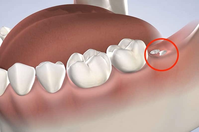 Common Issues with Wisdom Teeth