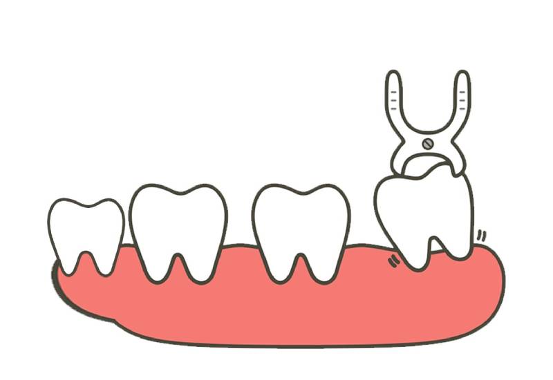 Addressing Concerns About Wisdom Teeth Extraction