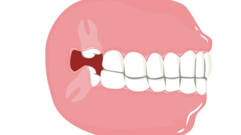 When Should You Opt for Wisdom Teeth Extraction?