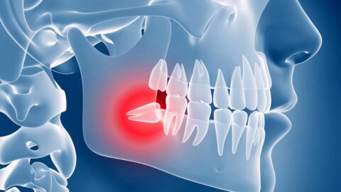 Should You Extract Wisdom Teeth? Answering Common Concerns