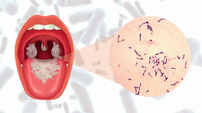 Classical Types of Diphtheria