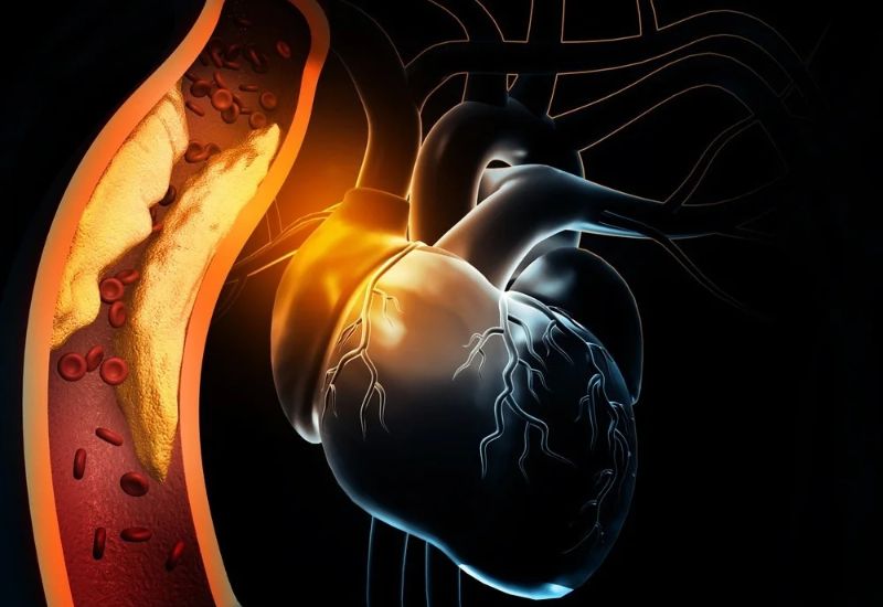 Causes and Risk Factors of Myocardial Infarction