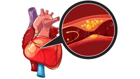 Coronary Atherosclerosis: Symptoms, Causes and Treatment