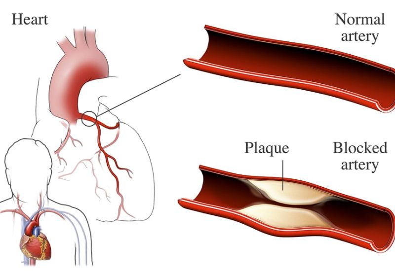 Understanding Coronary Atherosclerosis