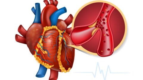 Myocardial Infarction: Causes and Warning Signs