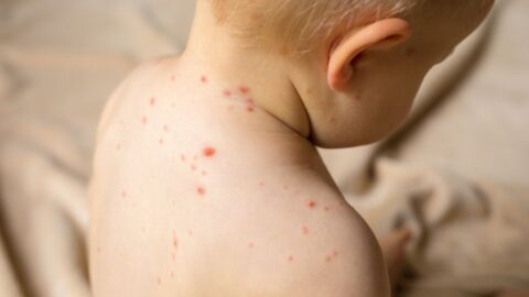 Pediatric Chickenpox: Common Questions Parents Often Ask