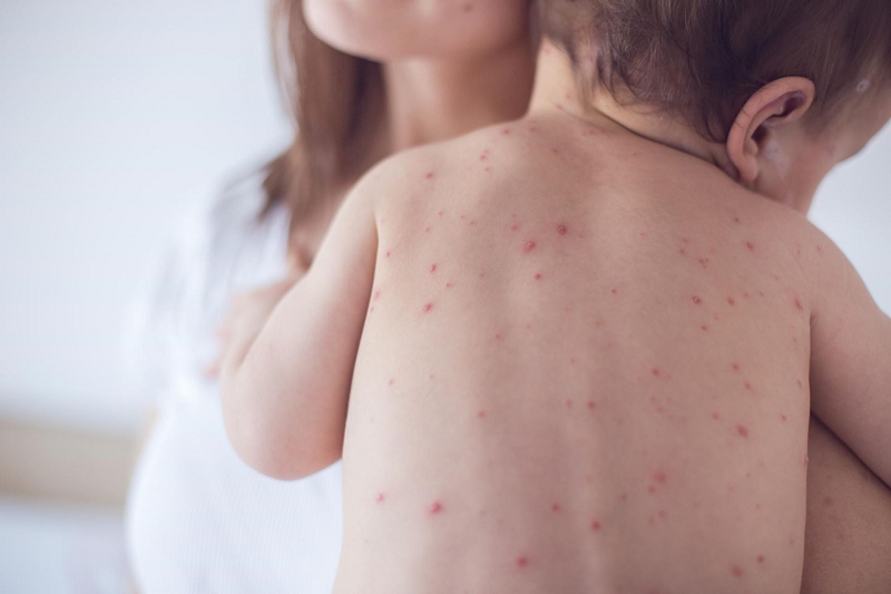 What Are the Common Signs of Pediatric Chickenpox?