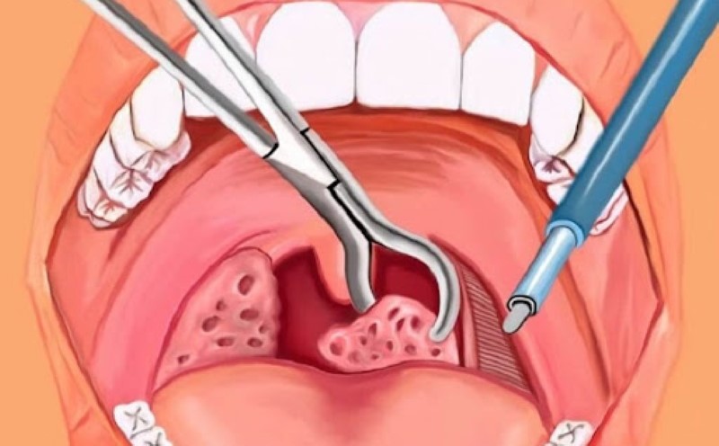 Complications of Tonsillitis