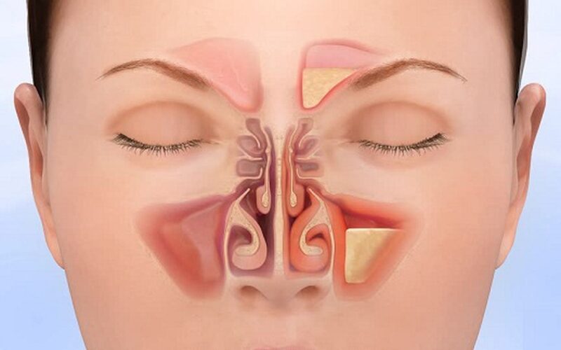 Types and Common Symptoms of Sinusitis