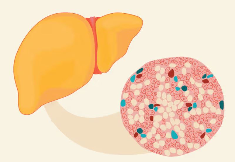 Key Characteristics Across the Stages of Fatty Liver Disease