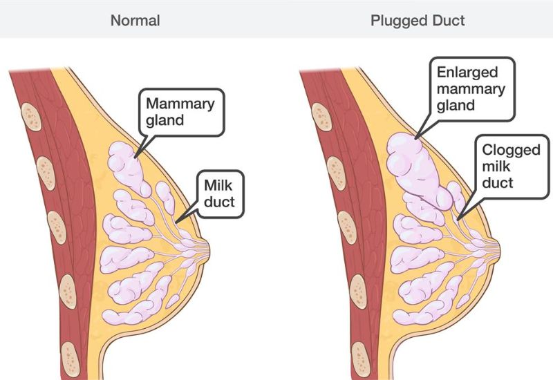 Symptoms of a Clogged Milk Duct