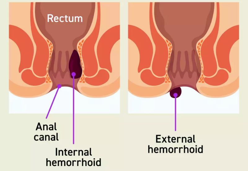 What Are External Hemorrhoids?