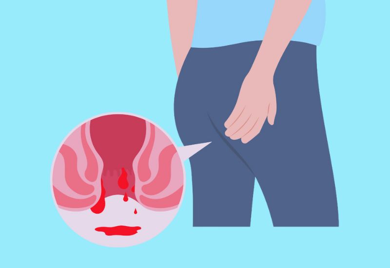 Understanding Hemorrhoids and Their Stages