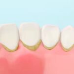 Tartar Buildup and Its Impact on Oral Health