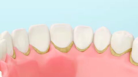 Tartar Buildup and Its Impact on Oral Health