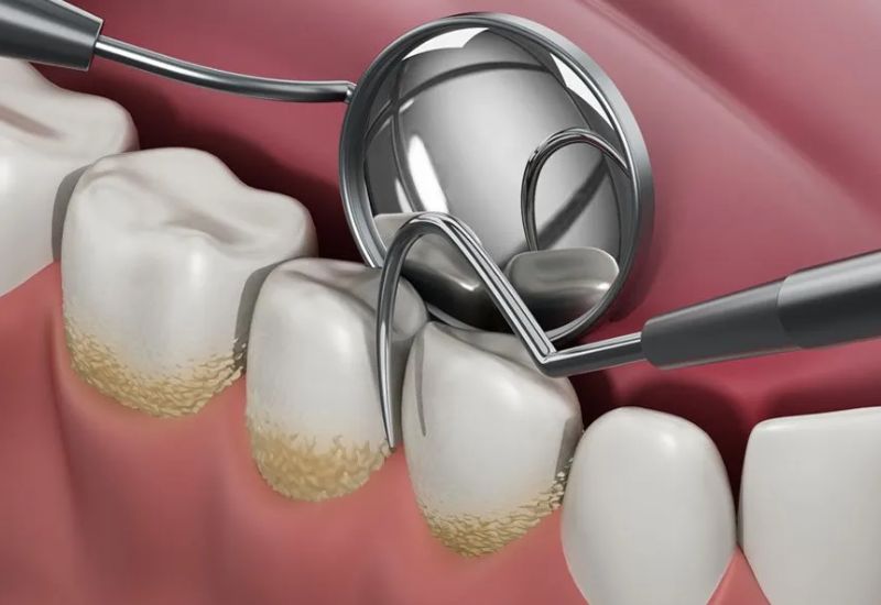 What is Dental Tartar?