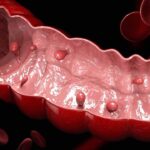 Adenomatous Colon Polyps: Causes and Treatment