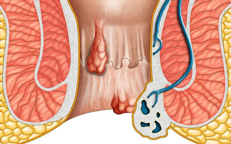 Overview of Hemorrhoids: Causes and Symptoms