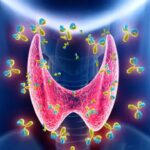 Causes of Hyperthyroidism and Effective Prevention Strategies