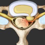 5 Essential Facts About Herniated Disc Disease