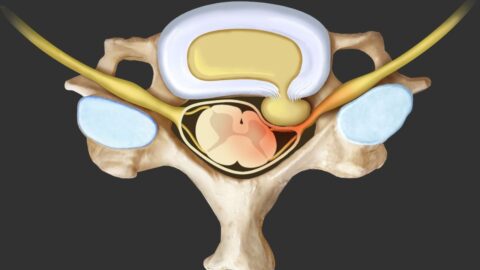 5 Essential Facts About Herniated Disc Disease