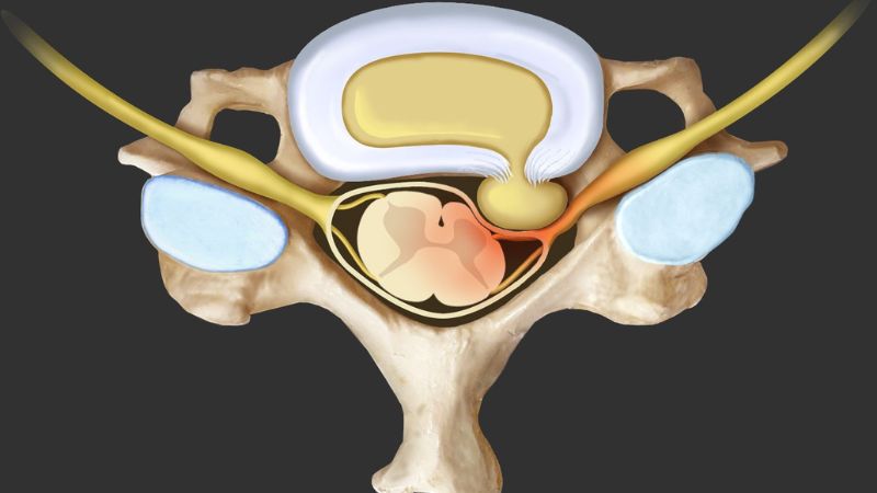 What Is a Herniated Disc?