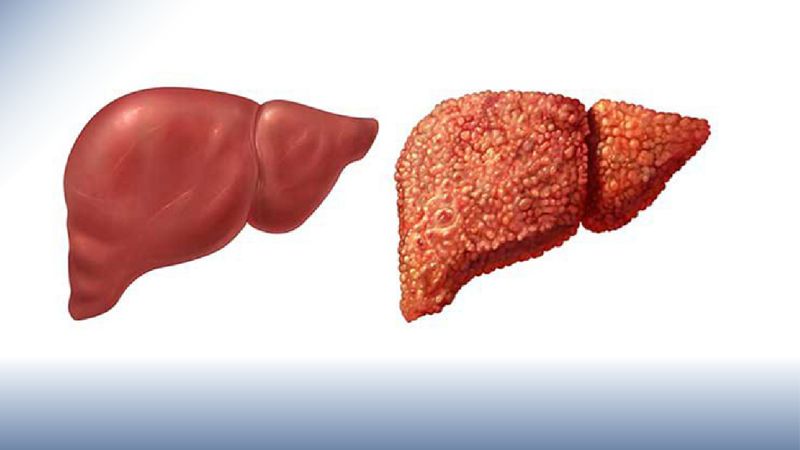 The Consequences of Liver Cirrhosis and Effective Treatment Approaches